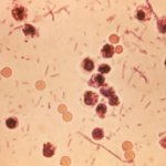 Shigella Death Kerala case involving health department complaint and disease investigation