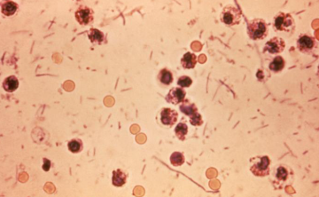 Shigella Death Kerala case involving health department complaint and disease investigation
