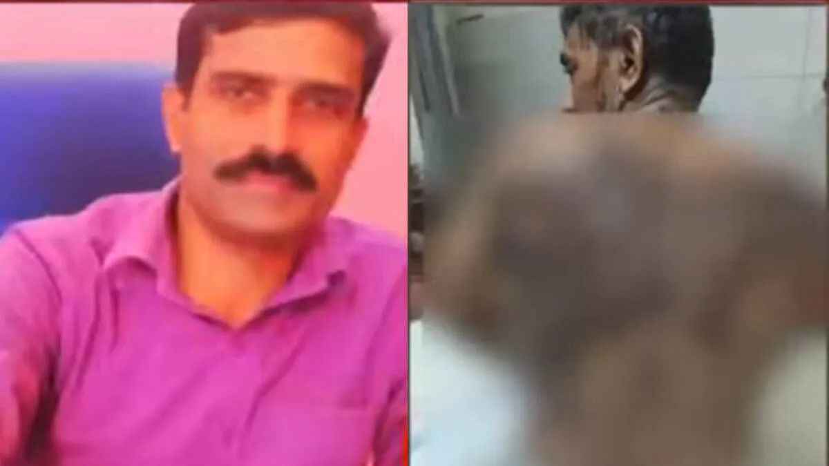 Palakkad Acid Attack victim undergoing treatment after serious assault